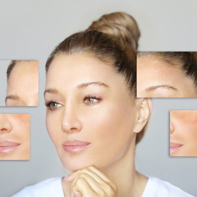 Hyperpigmentation. A guide to caring for hyperpigmented skin